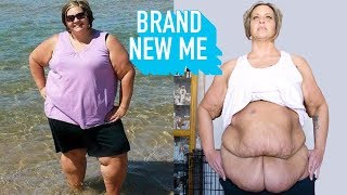 I Lost 188lbs – Now I’m Losing My Excess Skin | BRAND NEW ME