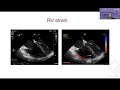 2. Right heart dysfunction in severe lung disease. Dr. Andy Roscoe