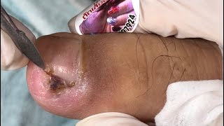 Ep_6557 Ingrown toenail removal  👣 เอาเล็บออกแล้ว..พอเล็บขึ้นใหม่ทำไมเจ็บ 😄 (clip from Thailand)