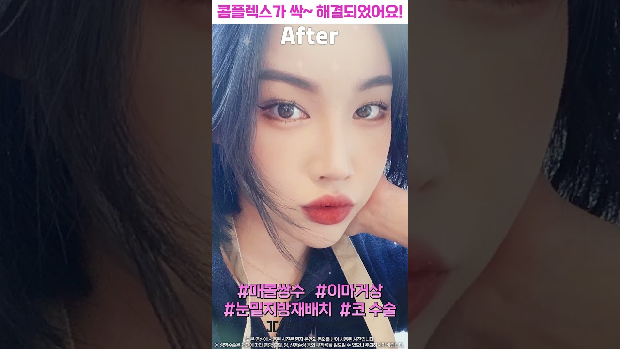 [JAYJUN Phẫu thuật thẩm mỹ & Da liễu] Ngay lập tức tôi đã quyết định phẫu thuật vì họ đã giải quyết chính xác nỗi lo của tôi. Tôi rất hài lòng~!