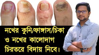 নখের কুনি দূর করার উপায় / নখের ফাঙ্গাস দূর করার সহজ উপায় / নখের চিকা দূর করার উপায় / নখের কালো screenshot 2