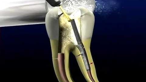 Removal of a post using ultrasonics | Dentsply Sirona