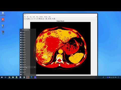 Liver Cancer Detection in Matlab