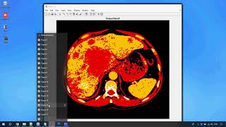 Liver Cancer Detection in Matlab