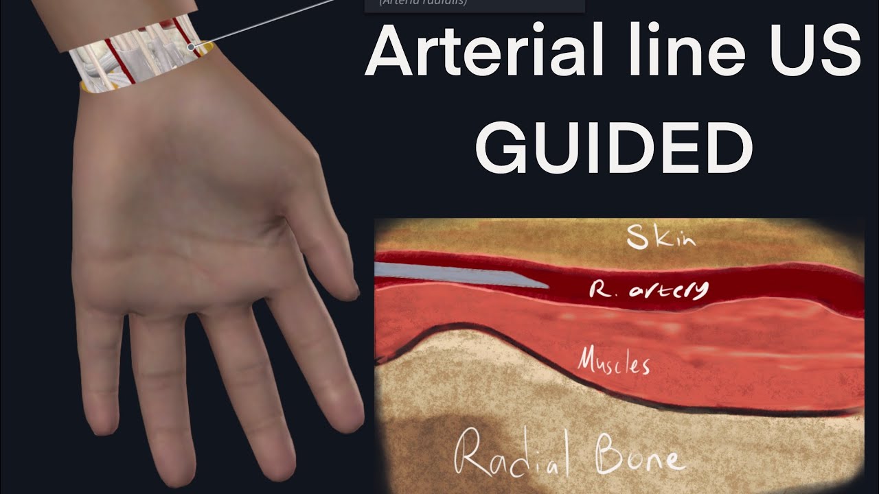 Radial arterial line cannulation ultrasound guided in plane YouTube