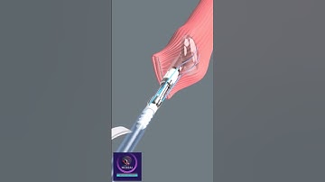 Laparoscopic Esophageal Surgery