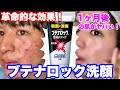 【１ヵ月間で！】強制的にニキビを治す方法！