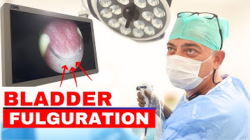 Bladder Fulguration – Watch the Procedure That Ended 4 Years of Pain! #cystitis