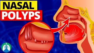 Nasal Polyps (Medical Definition) | Quick Explainer Video by Respiratory Therapy Zone 2,659 views 2 months ago 3 minutes, 35 seconds