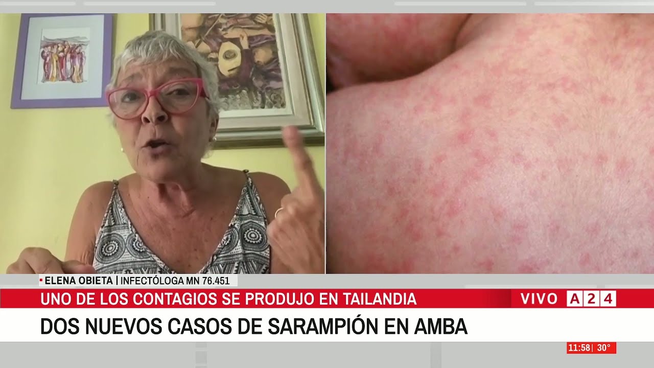 El sarampión vuelve a preocupar: advierten sobre su contagio y en qué casos puede ser fatal