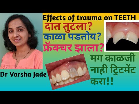 #Broken teeth#Dentaltrauma Treatment for broken teeth in Marathi||दात तुटल्यास काय करावे?तुटलेले दात