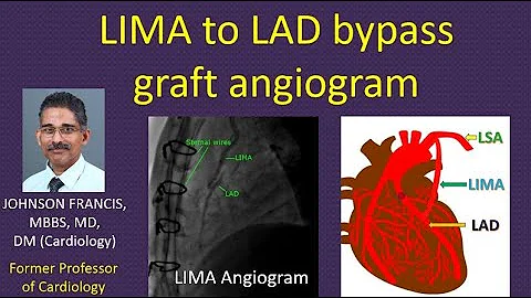 LIMA to LAD bypass graft angiogram