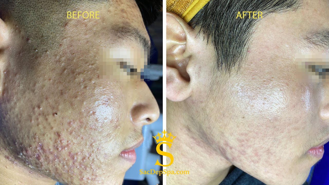 Download Acne Treatment For "Hung" (P20) | Điều Trị Mụn Cho Hùng (P20) - SacDepSpa#231