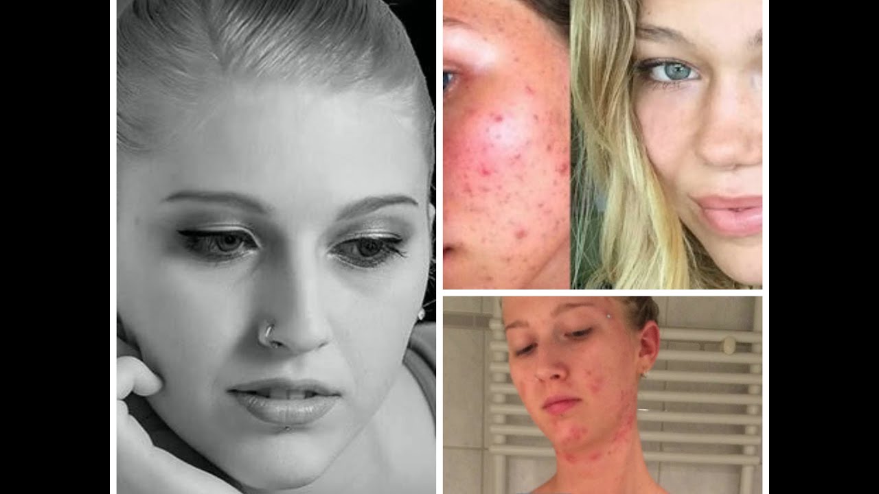 How to wear no makeup with acne How to wear no makeup with acne