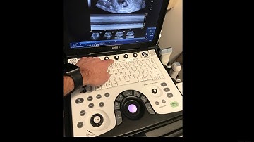 How to measure a FHB using M-Mode