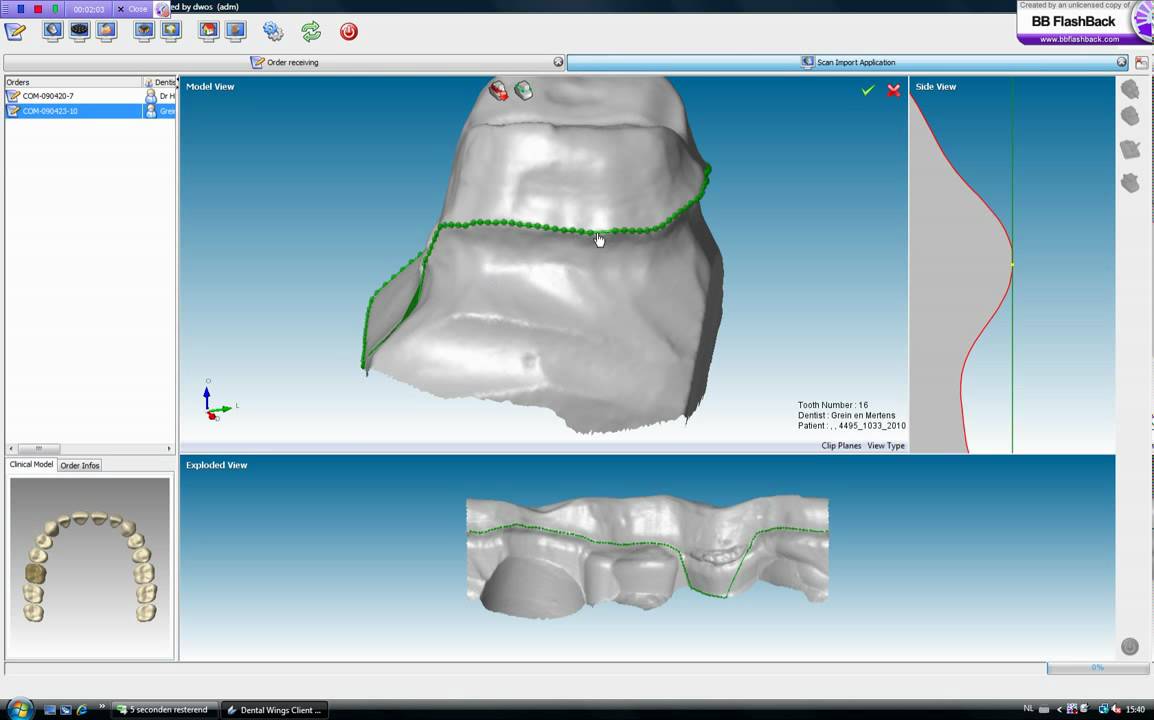 DWOS (dentalwings) coping YouTube