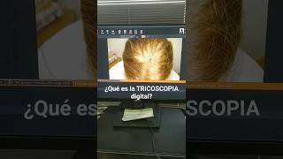 TRICOSCOPIA digital Lo más USADO en ALOPECIA #shorts