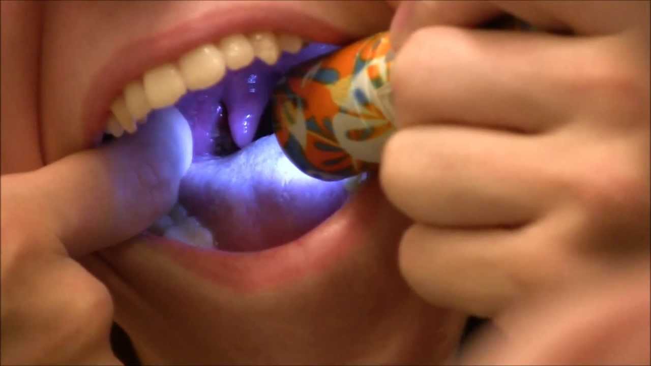 Tonsil Stones - YouTube