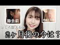 ほくろ除去2ヶ月後・・・