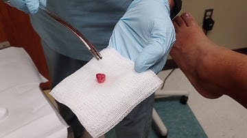 Endometrial Polyp Removal with Office Hysteroscopy