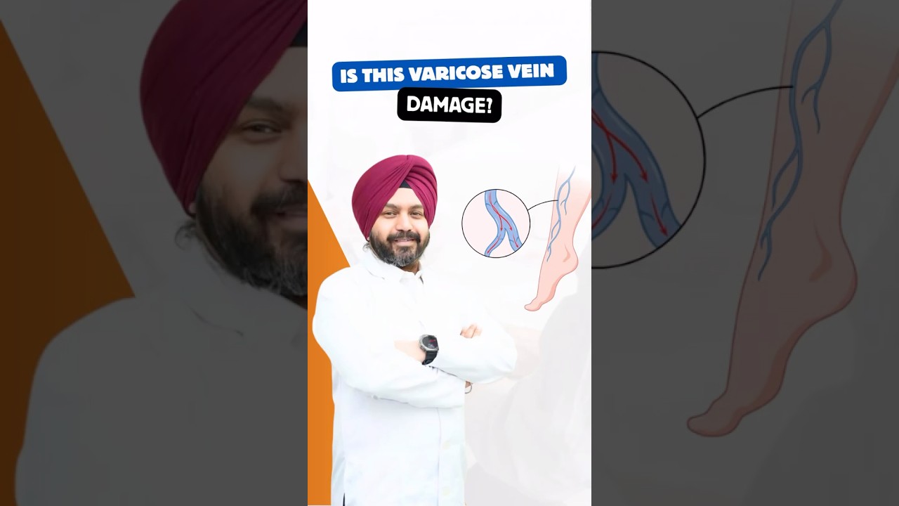 Varicose veins explainer thumbnail