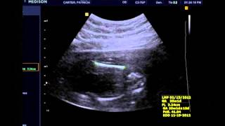 It's a girl!!!!! 20 weeks 1 day