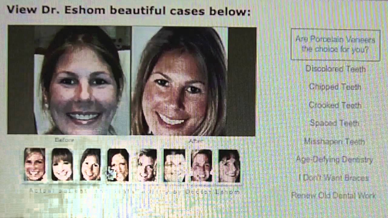 Porcelain Veneers Dental Before and After San Diego CA YouTube