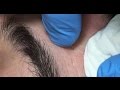 Acne Prevention - Deep Facial Cleansing