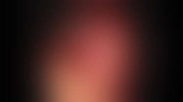 SA-13 Laparoscopic heminephrectomy in nonfunctioning moiety of a horseshoe kidney. SERDAR AYKAN,MD