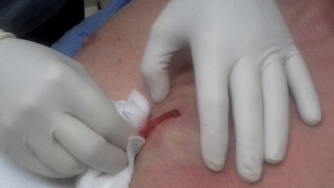 Dr Drains Staph Infection From My Chest Youtube