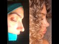 Nose job experience in Turkey estetik_burin