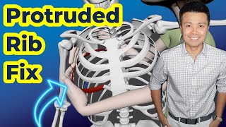2-step Rib Protrusion Fix for Pain Relief