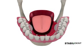 Stabil Dent - Lower Denture Stabilizers