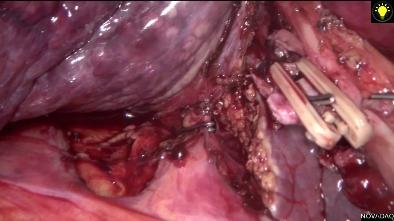 ICG immunofluorescence guided pure laparoscopic right hepatectomy for HCC in patient with cirrhosis