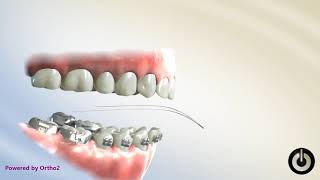 Famous Curve of Spee Correction, Lower Reverse Curve | Dental Braces | Temecula Valley, CA Profile