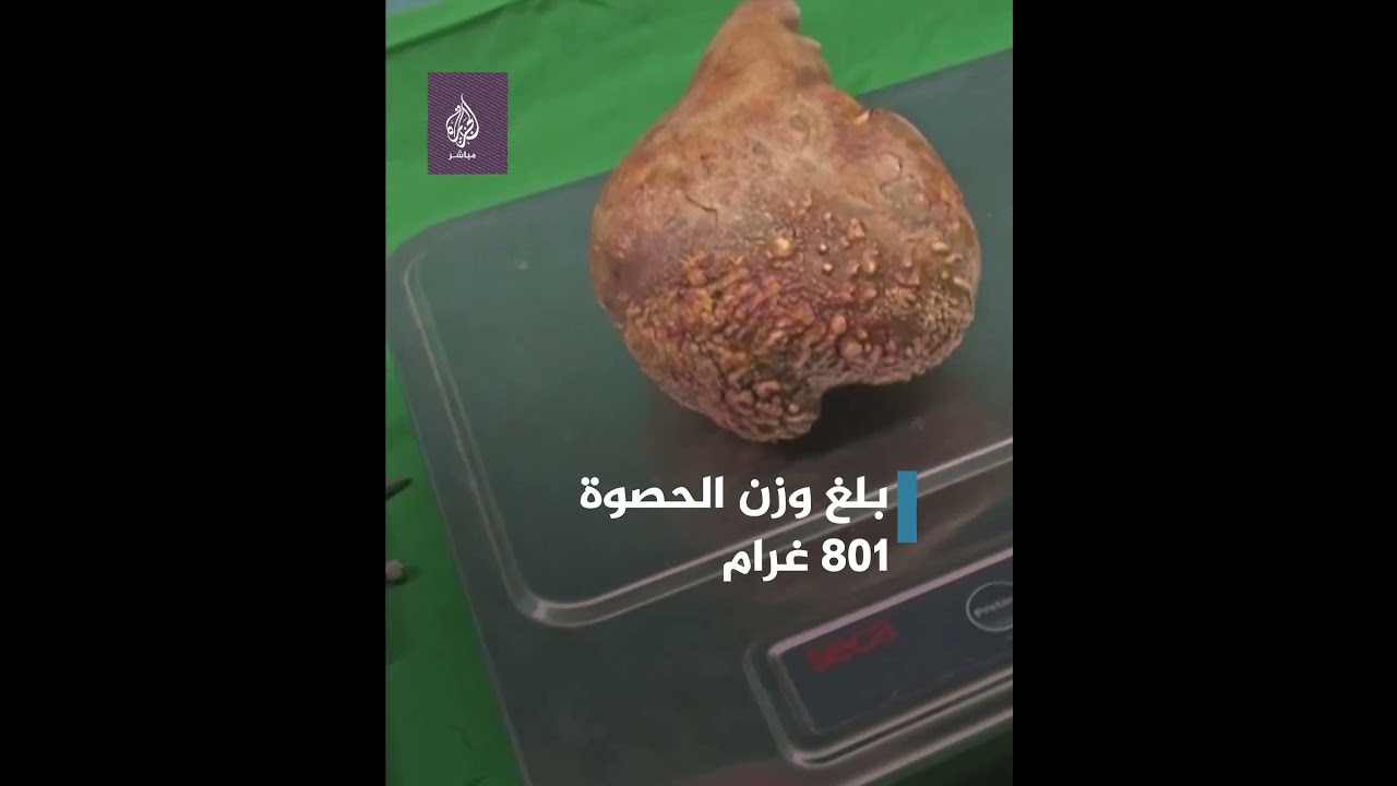 أكبر وأثقل حصوة كلوية بالعالم تدخل موسوعة غينيس