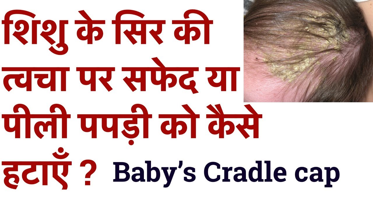 शिशु के सिर की त्वचा पर सफेद या पीली पपड़ी को कैसे हटाएँ Baby’s