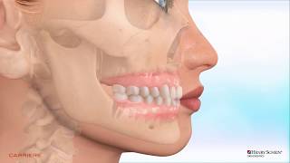 Carriere® Clear Motion™ Class II Appliance - Maxillary hypoplasia