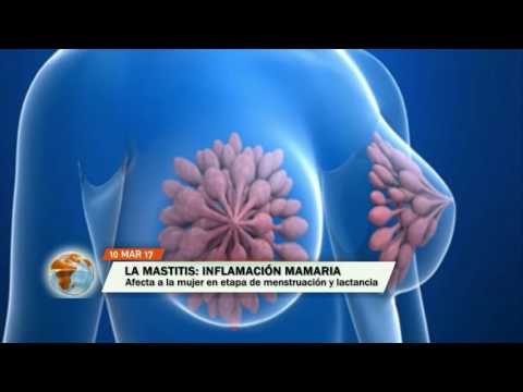 Vídeo: Mastitis En Un Gat (incloent Nul·lípars, Lactants I Altres): Com Tractar-se A Casa, Què Fer Amb La Mastopatia (mètodes De Tractament)