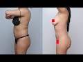 Lipo 360 BBL: Model Makeover with Liposculpture Brazilian Butt Lift