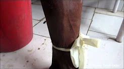 Tourniquet test - Wikipedia, Tourniquet Test - CDC, Tourniquet Test - CDC, Performance of the Tourniquet Test for Diagnosing Dengue in Peru, Tourniquet Test for Dengue Diagnosis: Systematic Review and Meta ..., Tourniquet test | definition of tourniquet test by Medical dictionary