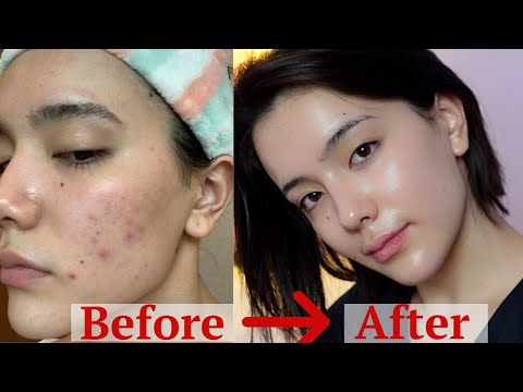 how I got rid of my ACNE after 8 years - ONLY thing worked