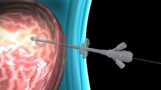 Percutaneous endoscopic gastrostomy