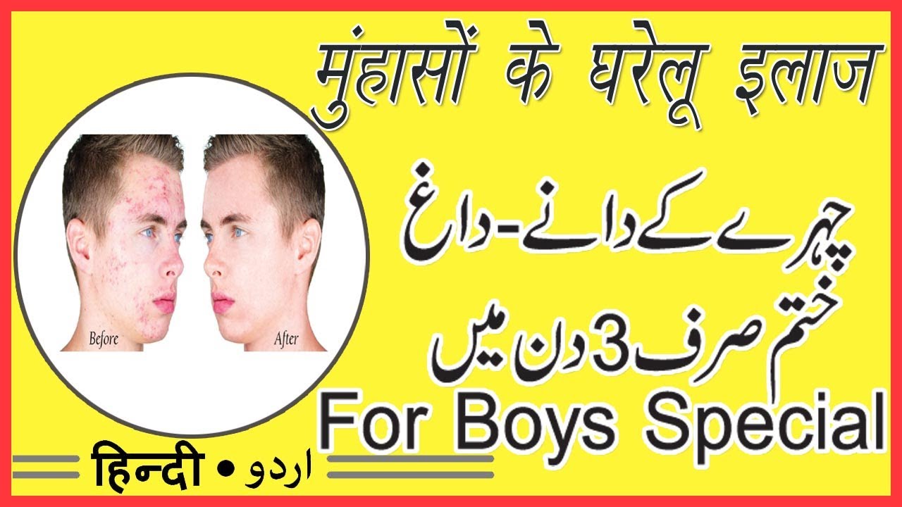 pimple remove for men in hindi|boys pimple removal on face at home|by sanam
