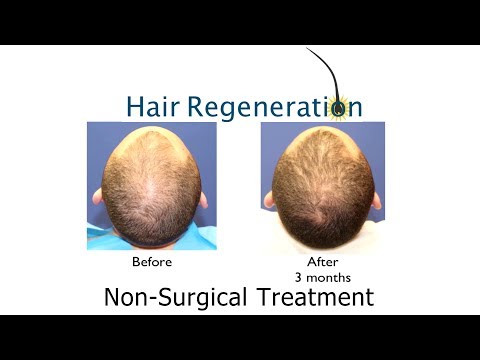 A Hair Transplant Alternative that Manages Loss and Thickens Hair without Surgery