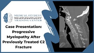 Case Presentation: Progressive Myelopathy After Previously Treated C2 Fracture