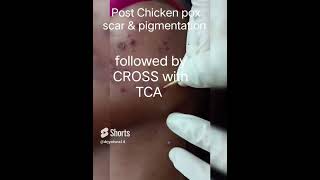 Chicken pox scar and pigmentation