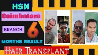 Coimbatore Branch after HT 6 months result/#hairtransformation #beforeandafter #hsn