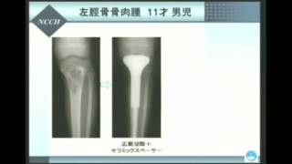 骨軟部腫瘍の診断・治療と今後について  川井 章