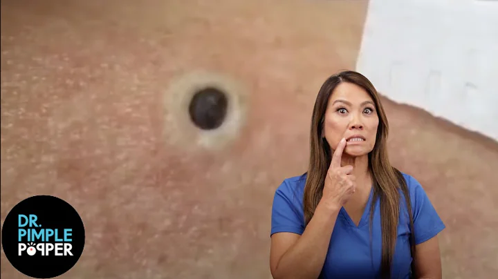 85 Year Old Blackhead! Dr Pimple Popper Most Popul...